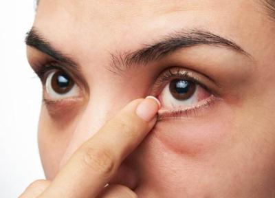 خشک شدن چشم چه دلایلی می تواند داشته باشد؟